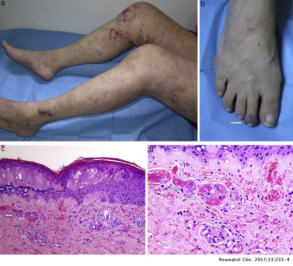 Sindrome Antifosfolipido