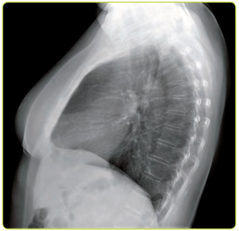 Figura 12. Radiografía lateral de tórax.