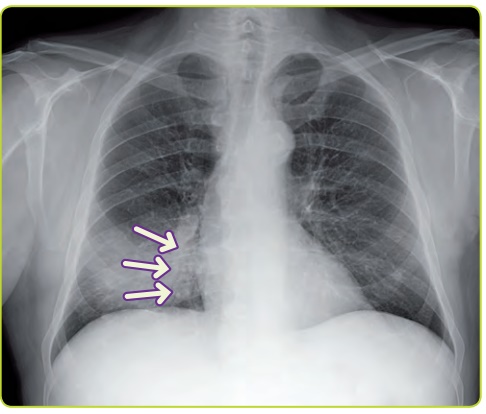 Figura 15. Consolidación del lóbulo medio en la que se aprecia el signo del broncograma aéreo.