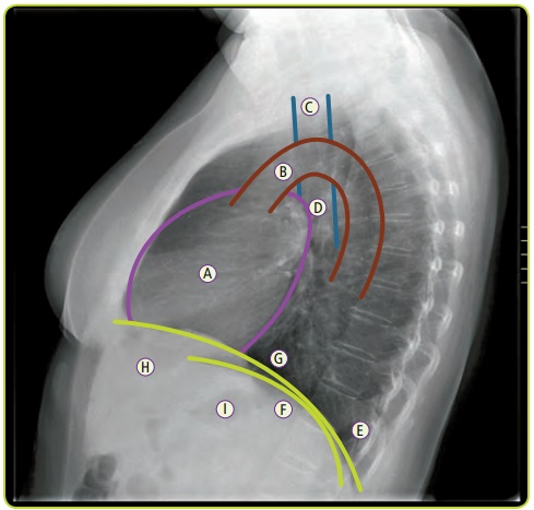 Figura 9. Mediastino en radiografía lateral. A: Corazón. B: Cayado aórtico. C: Tráquea. D: Hilio. E: Ángulo costofrénico. F: Diafragma izquierdo. G: Diafragma derecho. H: Hígado. I: Burbuja gástrica.