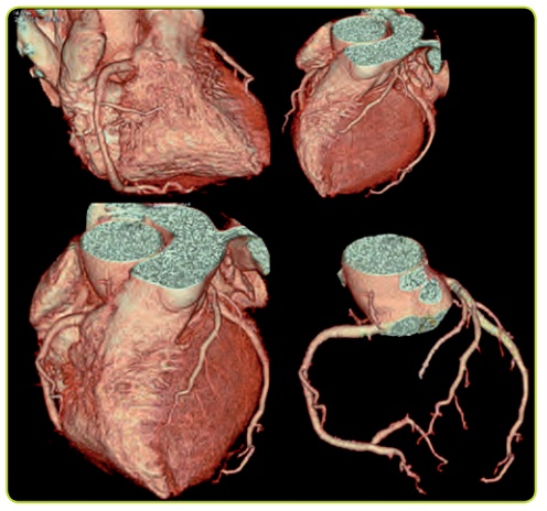 Figura 20. Reconstrucción tridimensional de las coronarias por TC