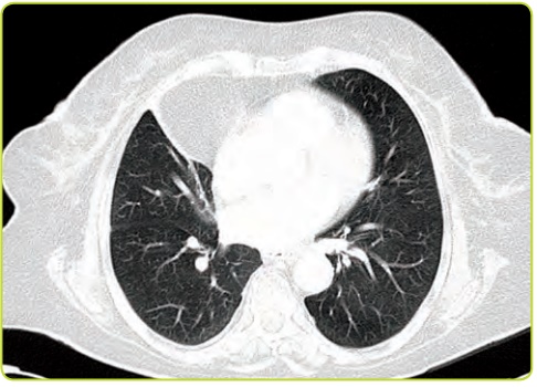 Figura 21a. Ventana pulmonar.