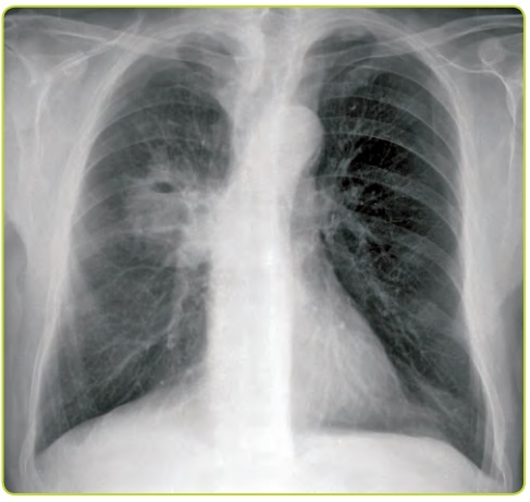 Figura 38a. Absceso pulmonar en radiografía simple.