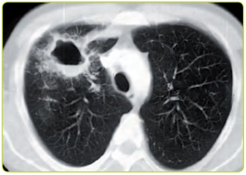 Figura 38b. Absceso pulmonar en TC.