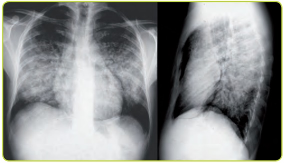 Figura 40. Hemorragia pulmonar bilateral.