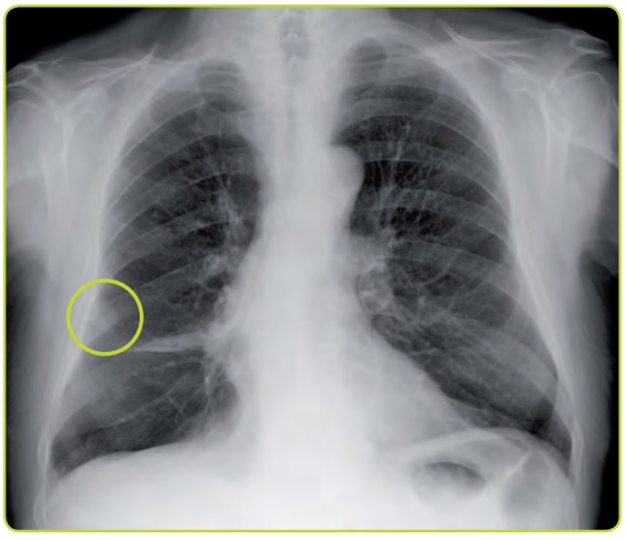 Figura 44a. Nódulo pulmonar solitario.
