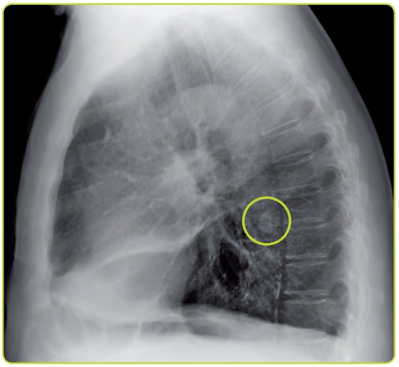 Figura 44b. Nódulo pulmonar solitario.