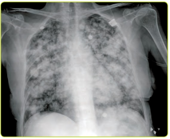 Figura 46. Metástasis pulmonares múltiples.
