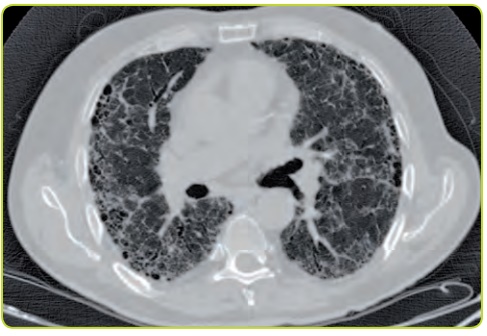 Figura 22. Imagen de TC de alta resolución que muestra fibrosis pulmonar