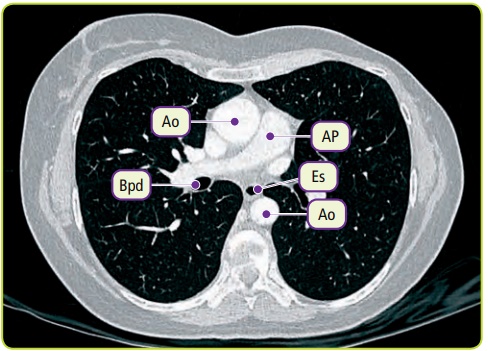 Figura 24c. Hilios pulmonares. Bpd: Bronquio principal derecho. Es: Esófago. Ao: Aorta. AP: Arteria pulmonar.