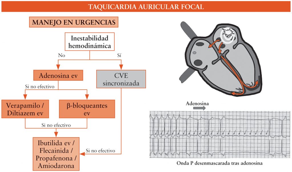 Figura 2. Taquicardia auricular focal.