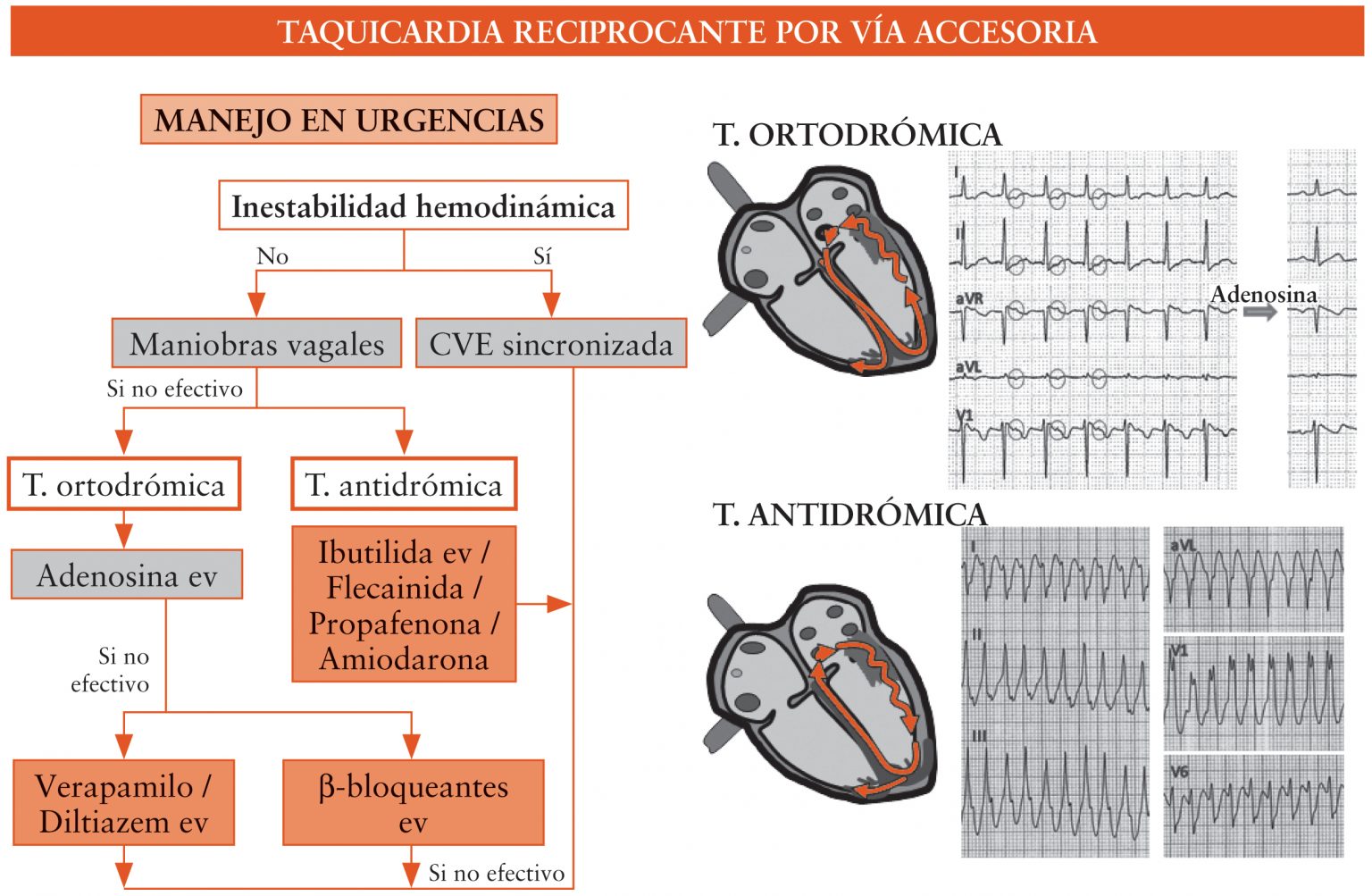 Tratamiento de las taquiarritmias supraventriculares en urgencias - Soy