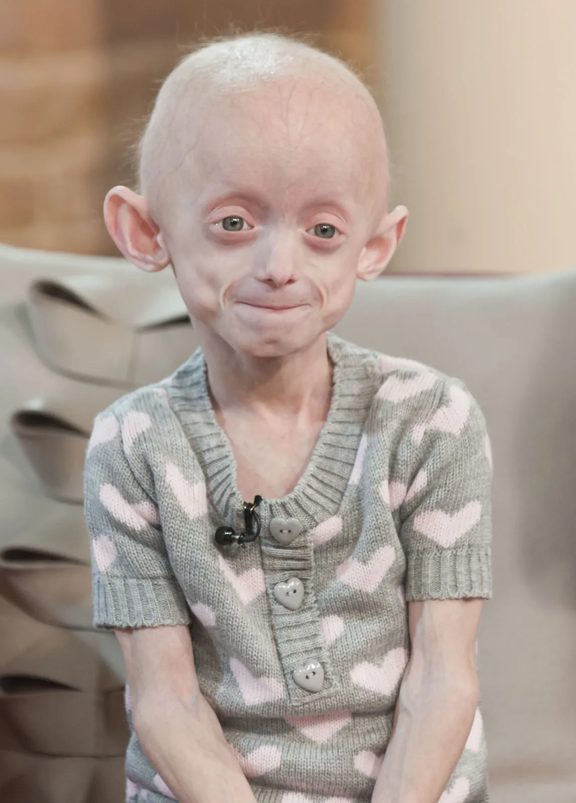 Qué es la progeria, síntomas y tratamiento