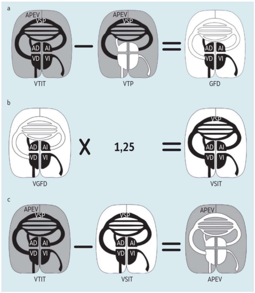 Presentaci&oacute;n esquem&aacute;tica del c&aacute;lculo de los par&aacute;metros volum&eacute;tricos con la termodiluci&oacute;n transpulmonar