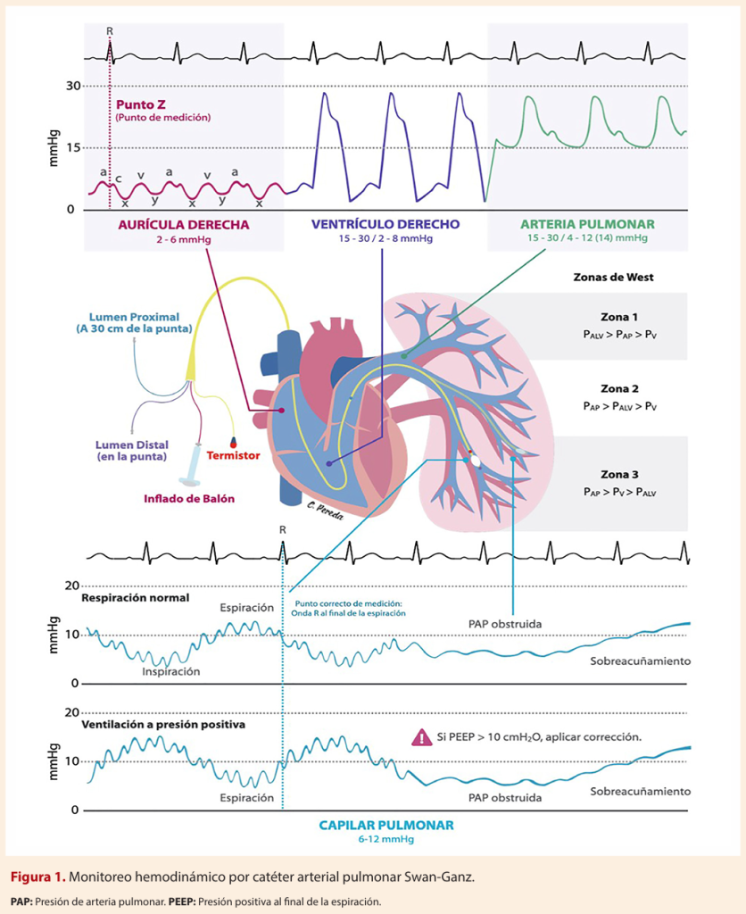 Monitoreo hemodin&aacute;mico por cat&eacute;ter arterial pulmonar Swan-Ganz.